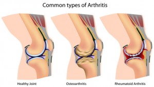 Arten von Arthrose und Arthritis