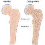 Osteoporose Vitamin K