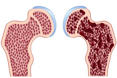 Osteoporose und Vitamin D Osteoporose und Vitamin D