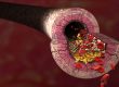 Arginin Arteriosklerose