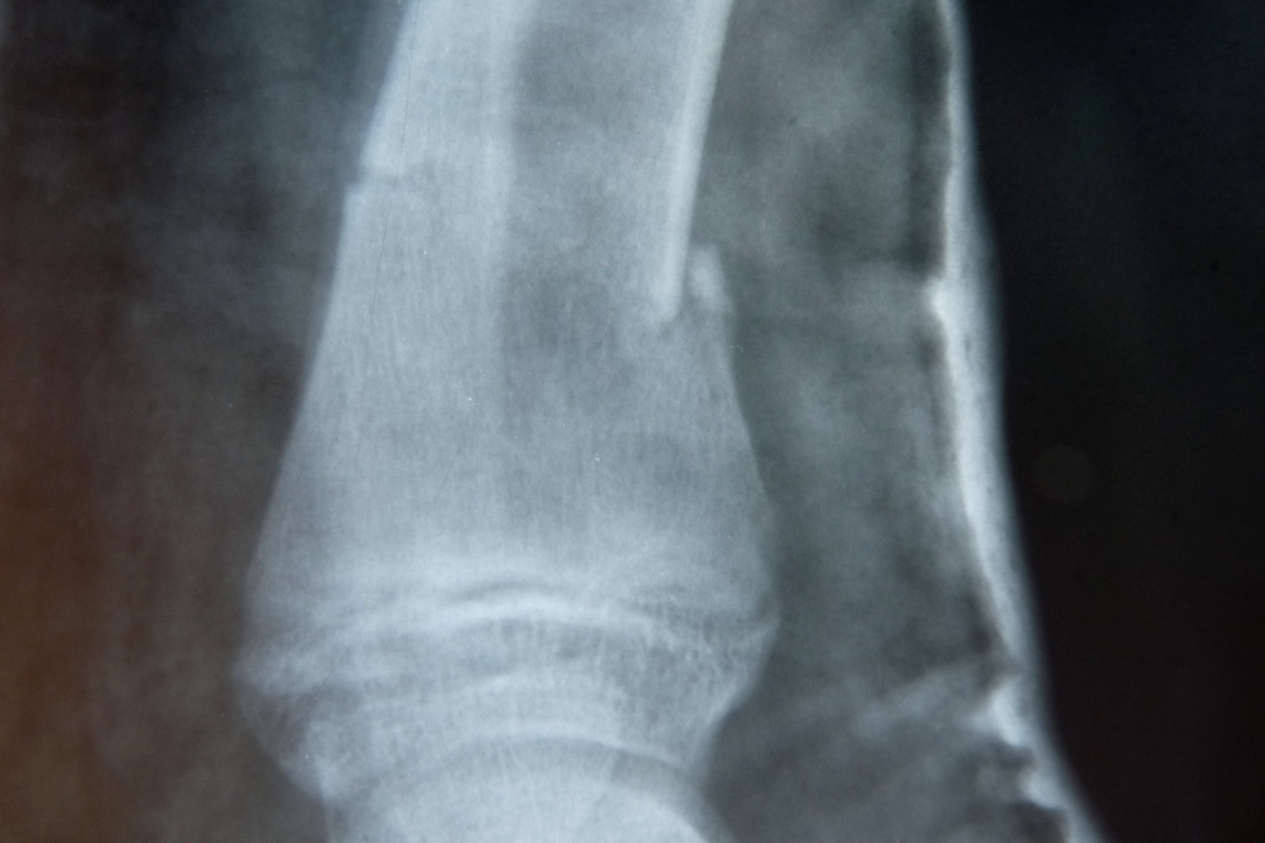 Gelenke Vitamin D3 Kalzium Gelenke Vitamin D3 Kalzium