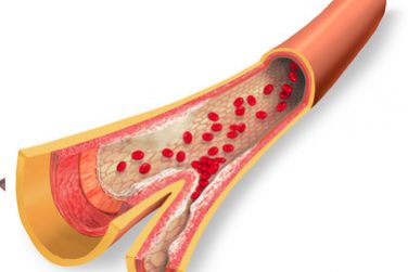 Cholesterinspiegel und Soyamilch Cholesterinspiegel und Soyamilch